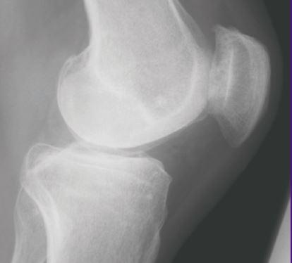 New Therapeutic Targets for Osteoarthritis Pain