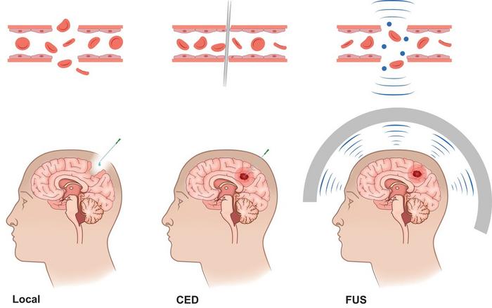 Example of interventional approaches to bypass physiologic blood-brain barrier (BBB) and blood-tumor barrier (BTB).