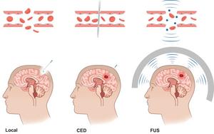 Example of interventional approaches to bypass physiologic blood-brain barrier (BBB) and blood-tumor barrier (BTB).