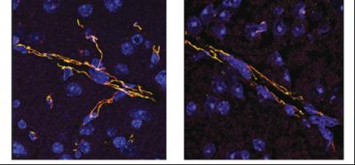 Blood Brain Barrier Breakdown
