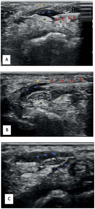 Non-Surgical Treatment Relieves Carpal Tunnel Syndrome
