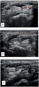 Non-Surgical Treatment Relieves Carpal Tunnel Syndrome