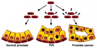 Prostate Cancer's Cellular Origins (5 of 5)