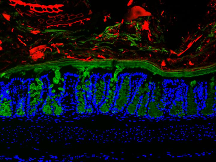 Disease variability in IBD