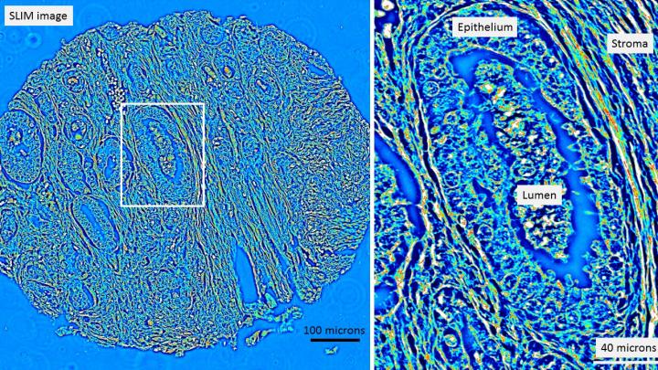 Quantitative Phase Images of An Unstained Prostatectomy Sample