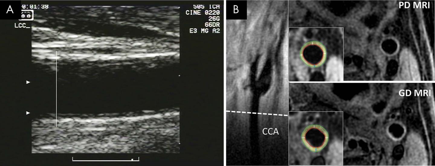 Images Show Common Carotid Artery Wall Thickness Assessment