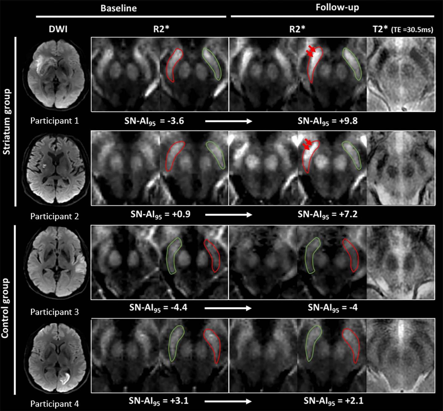 Iron measurements with MRI reveal stroke's im EurekAlert!