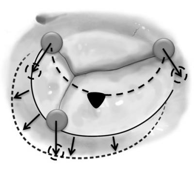Tricuspid Regurgitation
