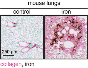 Iron accumulation drives fibrosis