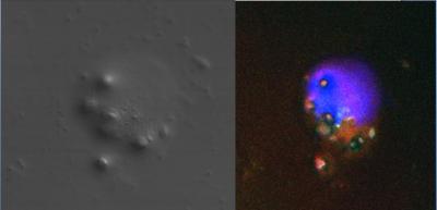 Macrophage (Blue Staining) Engulfing Dead Neutrophils (White Spots)