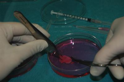Ovarian Tissue Being Prepared for Freezing and Storing