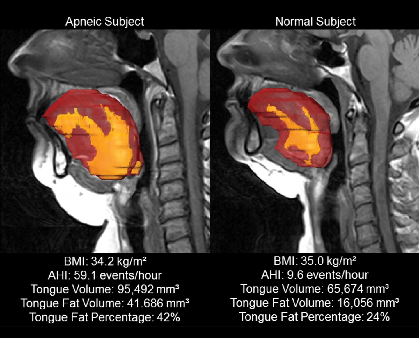 Tongue Fat In Patients With Ob [image] Eurekalert Science News Releases