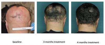 FDA-Approved Drug Restores Hair in Patients with Alopecia Areata