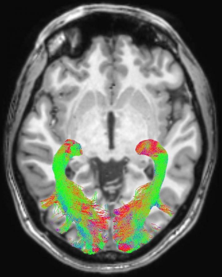 Figure 1 Left and right Optic Radiation