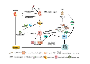 Chinese Medical Journal Review Explores the Role of Macrophages in the Progression of Acute Kidney Injury to Chronic Kidney Disease