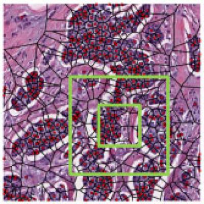 Computerized Analysis of Breast Cancer Tissue from Biopsy