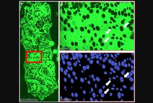 Bone marrow adipocytes provide early sign of - Vimarsana News