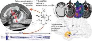 Overview of the seizure triggering electrodes and the brain reconstruction method.