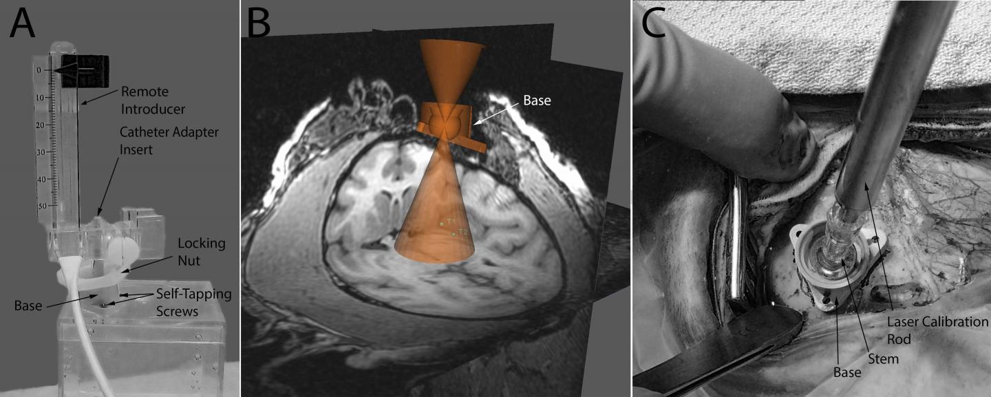 MRI Delivery of Neural Stem Cells