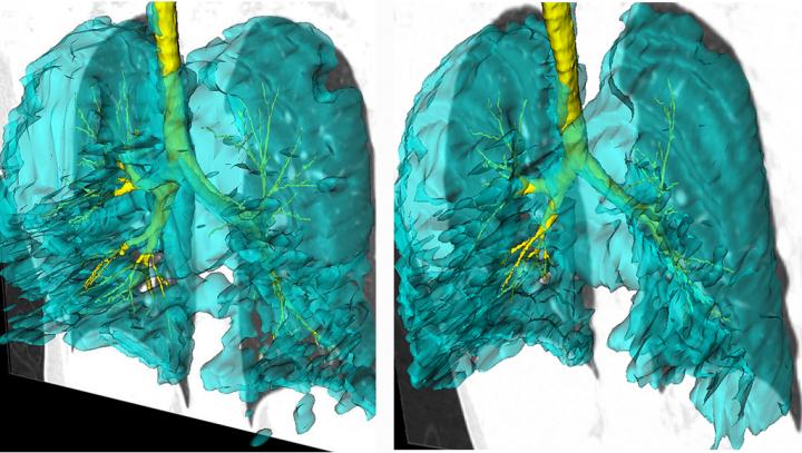 3D Images of Ventilation Defects in Twins with Asthma