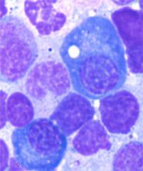 Bone Marrow Vacuoles