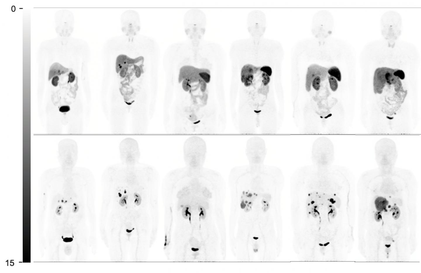 Comparison of whole-body maximum-intensity projections in 6 representative patients.