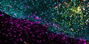 Cross-section of brain tumor with CAR T-cells