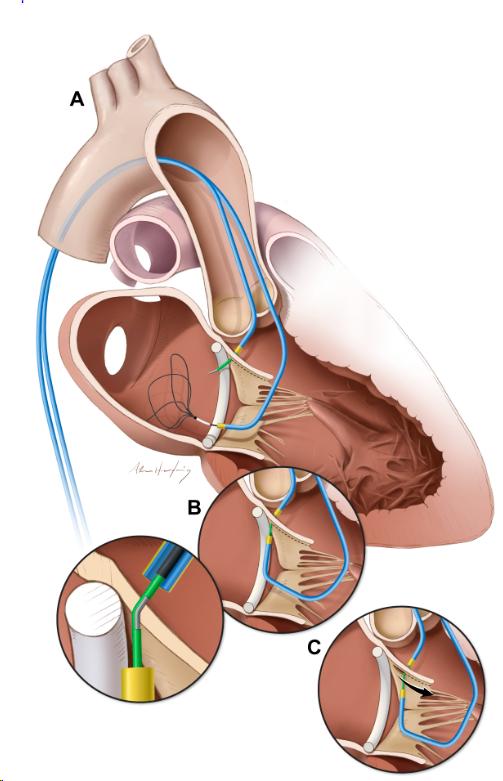 The LAMPOON Procedure