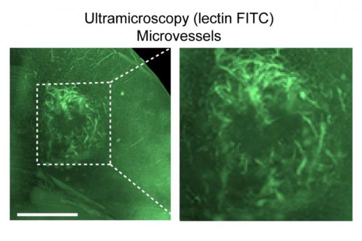 Brain Tumor Microvessels