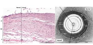 Ureteral electrothermal injury, characterized by damaged collagen bundles, with swelling and fragmentation of smooth muscle fibers, is visible via histology ex vivo (left panel, 20× magnification).
