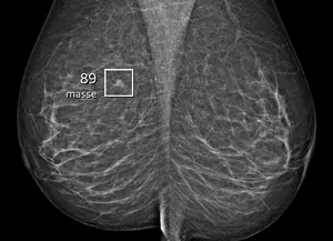 Screening mammogram of a 57-year-old woman