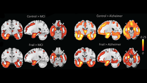 Cognitive Decline Not Always a Sign of Alzheimer’s Disease