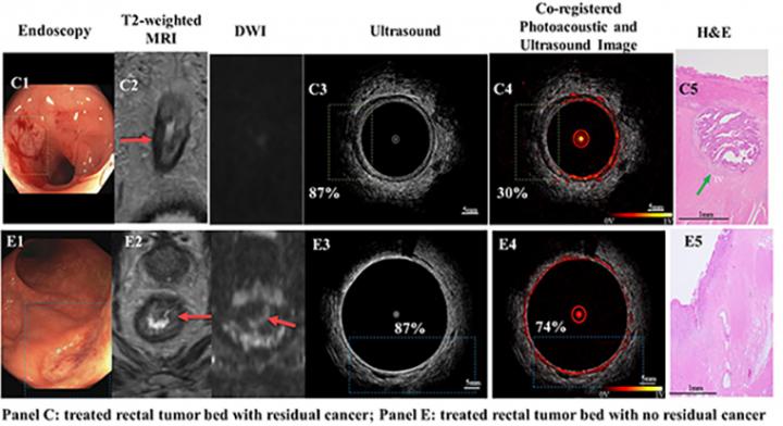 Using new imaging techniques in treating rectal cancer