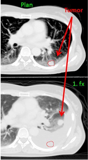 Lung Tumor Moves Position between One Scan and the Next