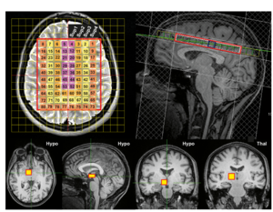 Brain regions selected for temperature measurement using magnetic resonance spectroscopy