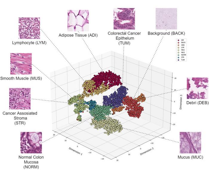 Sub-image of a cancer microscope slide analysed by artificial intelligence