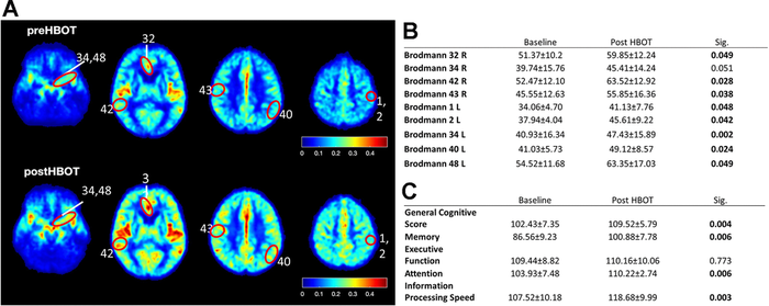 CBF and cognitive function are improved following HBOT of patients CBF and cognitive functions of six patients suffering from memory decline at baseline and following 60 HBOT sessions