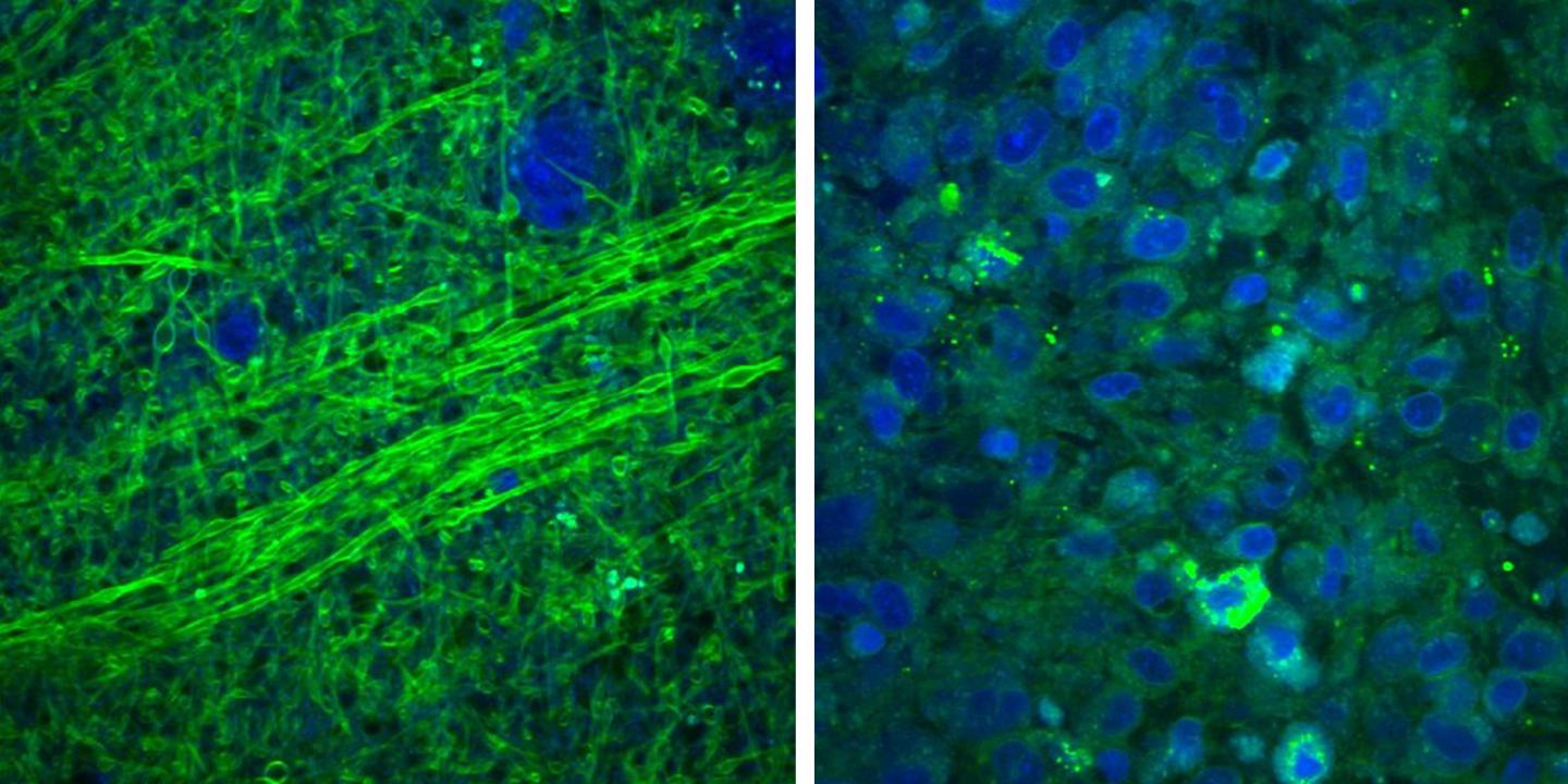 SRS Microscopy Shows Difference between Tumor, Normal Brain