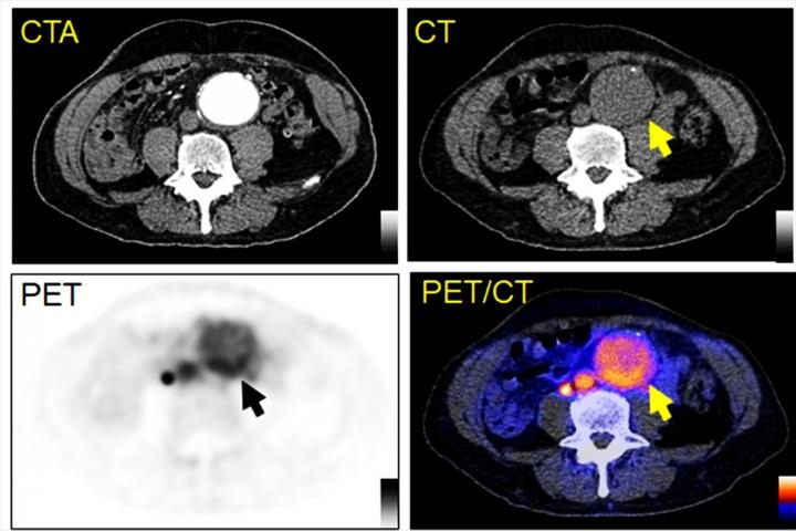 PET/CT image of a patient with an abdominal aortic aneurysm.