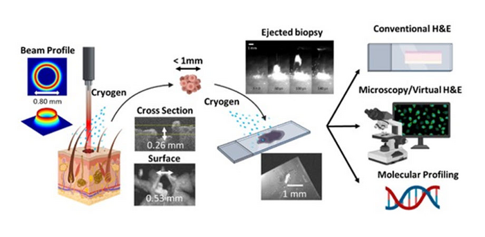 Overview of the novel laser microbiopsy system, which is fast and minimally invasive.