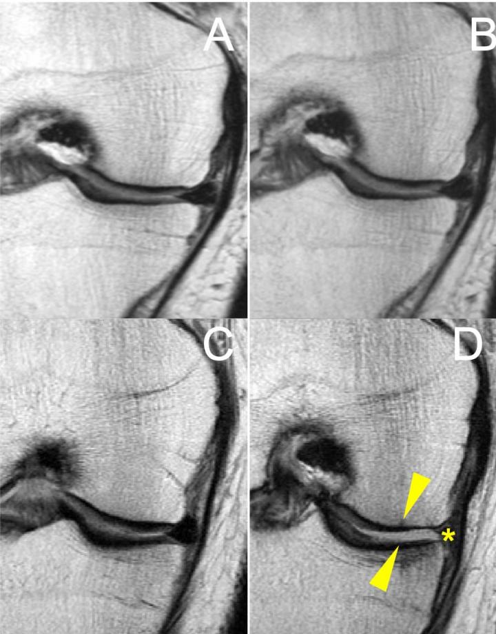 Racket Sports May Worsen Knee Arthritis