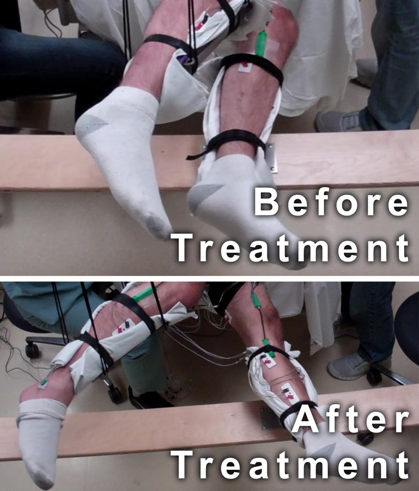 Movement before and after Treatment