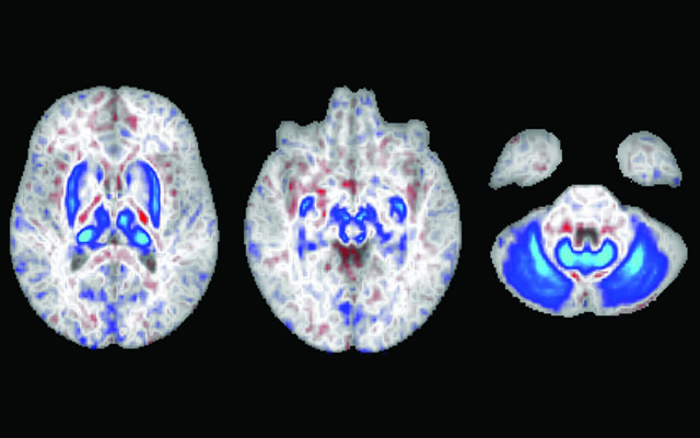 Hemochromatosis in brain, University of California San Diego