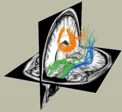 Baffling Chronic Pain Rewires Brain