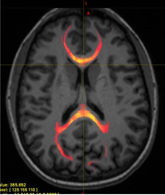 Concussion Alters How Information Is Transmitted Within the Brain