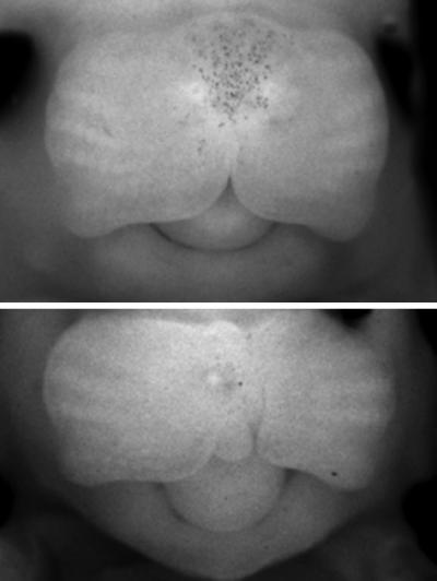 Genetics of Cleft Lip