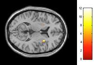 Brain MRI Shows Increased Activity in Right Insula