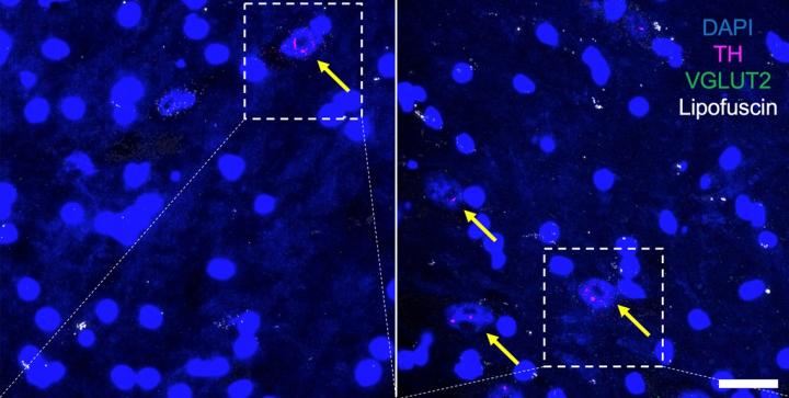 Dopamine neurons (magenta) carry VGLUT (green). Cell nuclei are in blue.