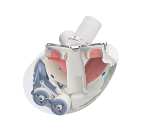 Aeson® total artificial heart. Image courtesy CARMAT.