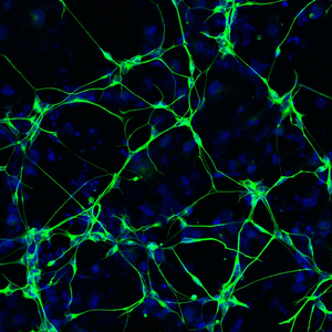 Neurons in Alzheimer's disease patient